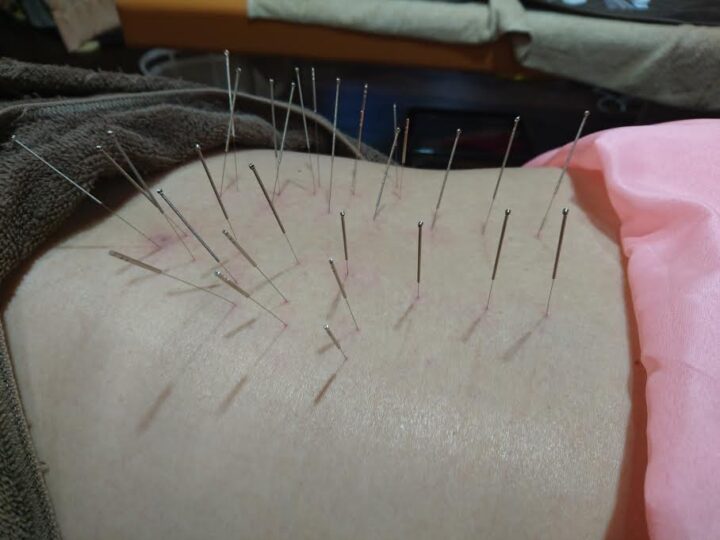 当院の鍼(針)灸による、ぎっくり腰,腰痛の施術期間や施術例の画像